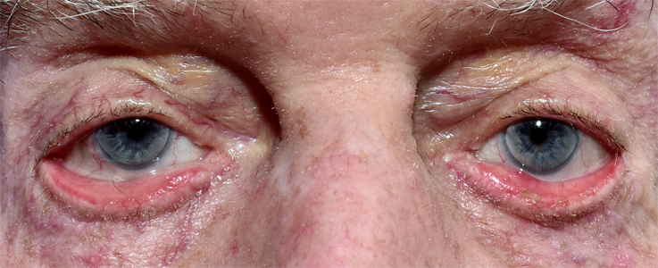 ocular Lymphoma.jpg